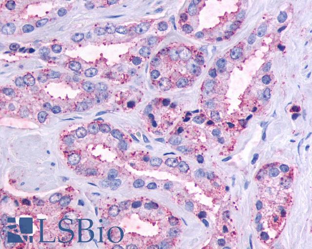 OR51E1 Antibody - Anti-OR51E1 antibody IHC of human Prostate, Carcinoma. Immunohistochemistry of formalin-fixed, paraffin-embedded tissue after heat-induced antigen retrieval.
