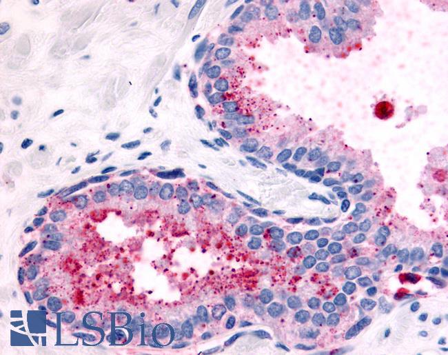 OR51E2 / PSGR Antibody - Prostate, Carcinoma