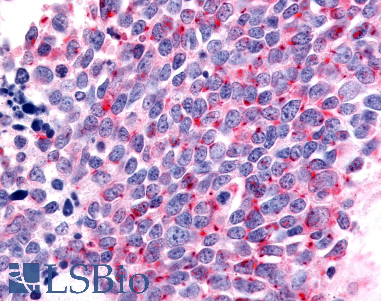 OR6K3 Antibody - Lung, Small Cell Carcinoma