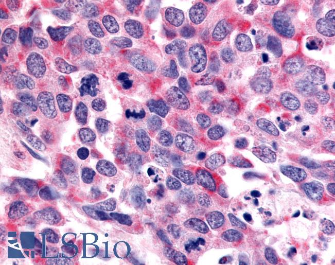 OR6K3 Antibody - Anti-OR6K3 antibody IHC of human Lung, Small Cell Carcinoma. Immunohistochemistry of formalin-fixed, paraffin-embedded tissue after heat-induced antigen retrieval.