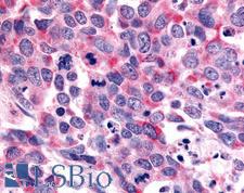 OR6K3 Antibody - Anti-OR6K3 antibody IHC of human Lung, Small Cell Carcinoma. Immunohistochemistry of formalin-fixed, paraffin-embedded tissue after heat-induced antigen retrieval.