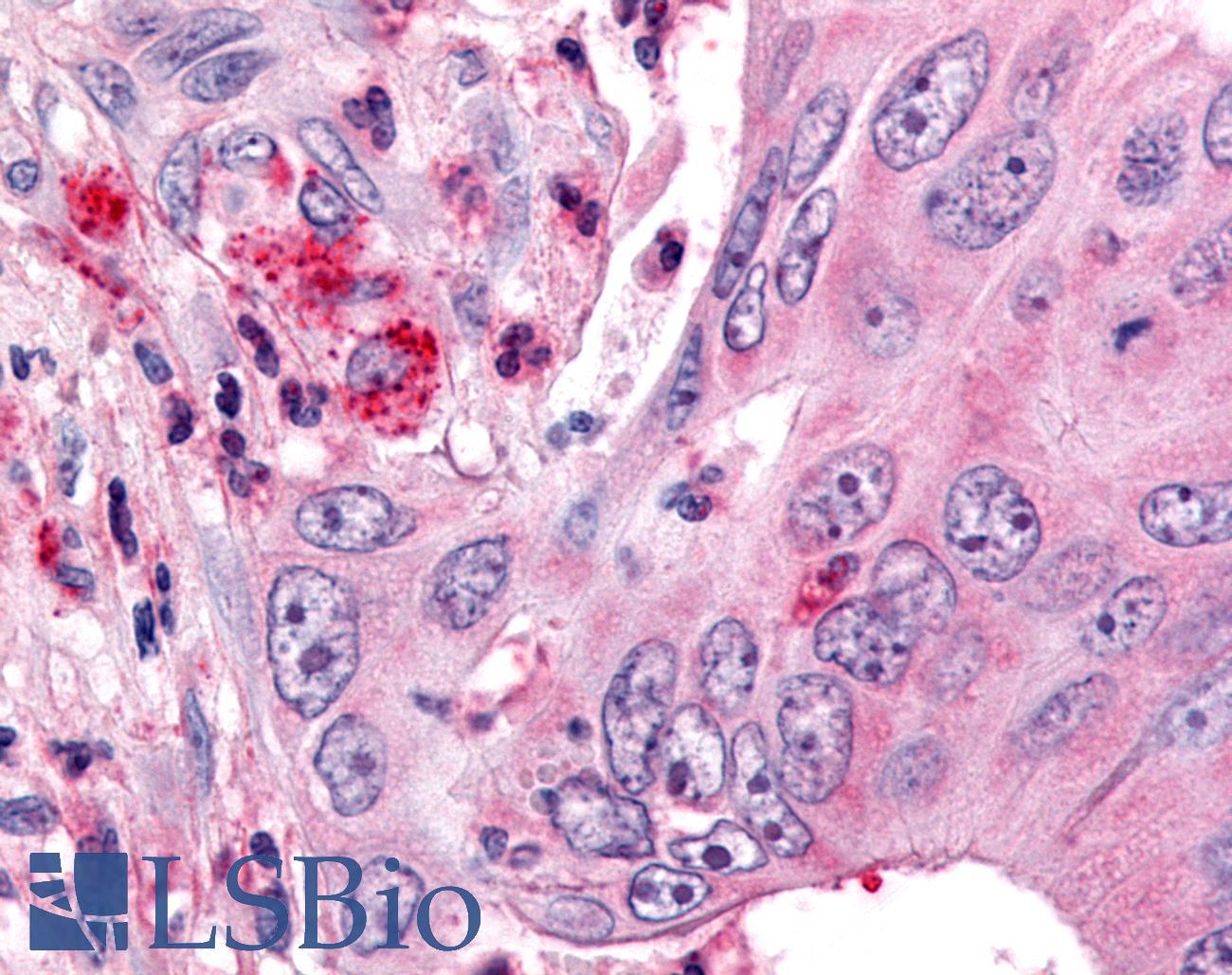 OR6K3 Antibody - Colon, Carcinoma