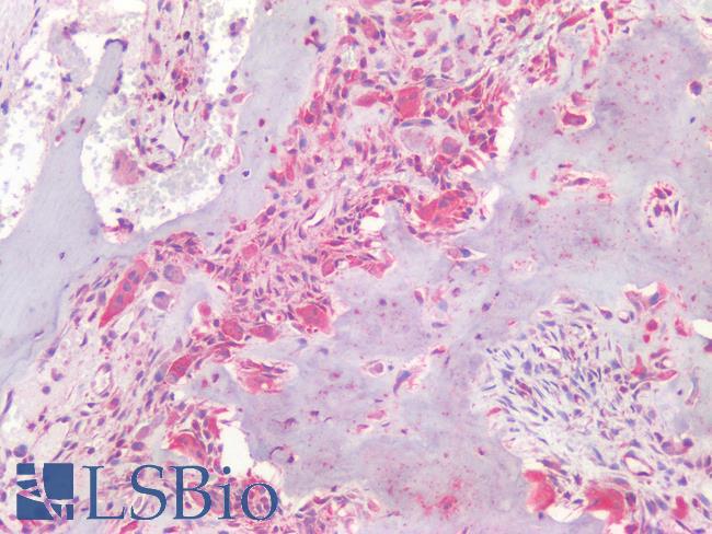 Osteocalcin Antibody - Human Osteoblastoma: Formalin-Fixed, Paraffin-Embedded (FFPE)