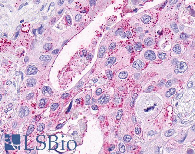 OXER1 Antibody - Pancreas, carcinoma