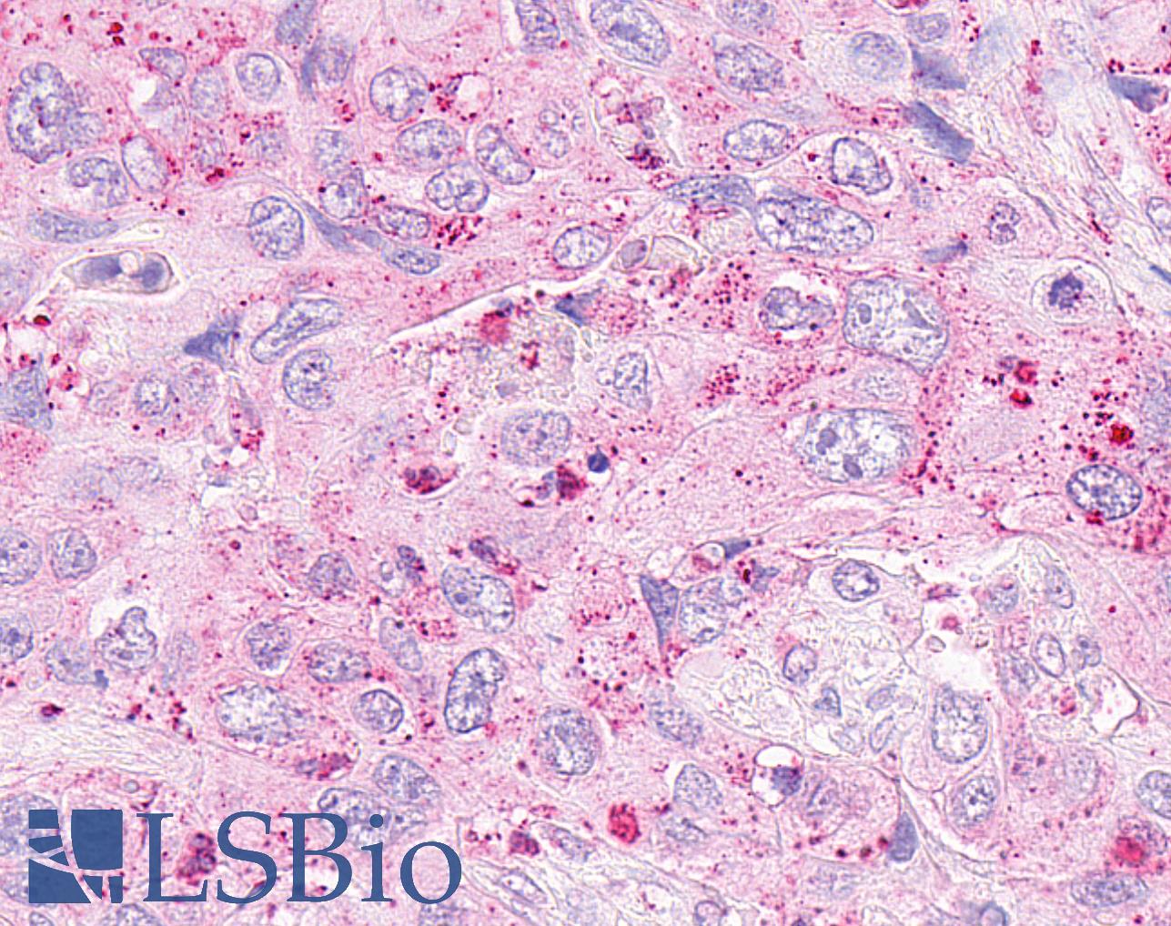 OXER1 Antibody - Anti-OXER1 antibody IHC of human Pancreas, Carcinoma. Immunohistochemistry of formalin-fixed, paraffin-embedded tissue after heat-induced antigen retrieval.