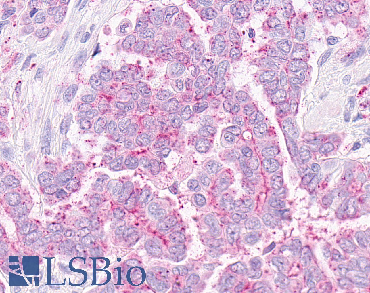 OXER1 Antibody - Anti-OXER1 antibody IHC of human Ovary, Carcinoma. Immunohistochemistry of formalin-fixed, paraffin-embedded tissue after heat-induced antigen retrieval.