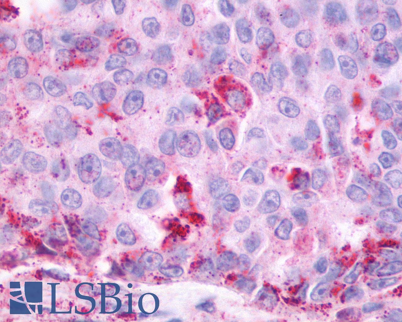 OXER1 Antibody - Lung, Non Small-Cell Carcinoma