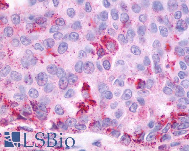 OXER1 Antibody - Lung, Non Small-Cell Carcinoma