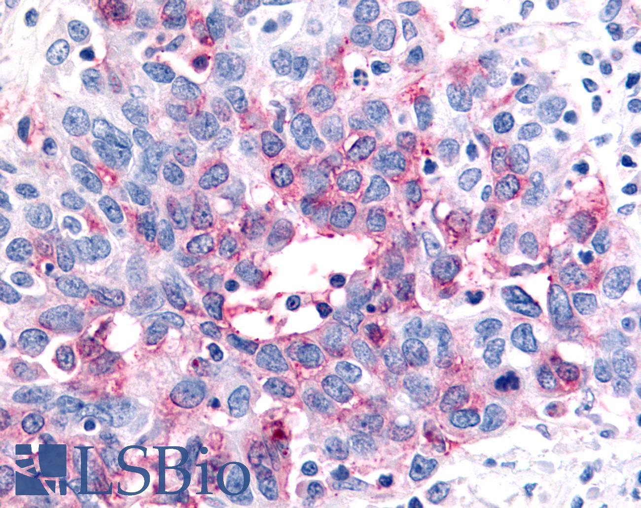 P2RY12 / P2Y12 Antibody - Ovary, Carcinoma