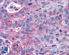 P2RY14 / GPR105 Antibody - Lung, non small cell carcinoma