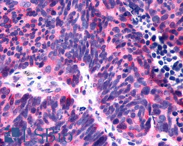 P2RY6 / P2Y6 Antibody - Anti-P2RY6 / P2Y6 antibody IHC of human Lung, Small Cell Carcinoma. Immunohistochemistry of formalin-fixed, paraffin-embedded tissue after heat-induced antigen retrieval.