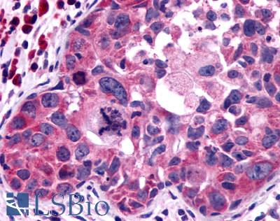 P2Y13 / P2RY13 Antibody - Breast, adenocarcinoma