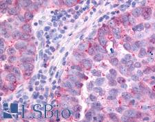 PAK6 Antibody - Anti-PAK6 antibody IHC of human Lung, Non-Small Cell Carcinoma. Immunohistochemistry of formalin-fixed, paraffin-embedded tissue after heat-induced antigen retrieval.