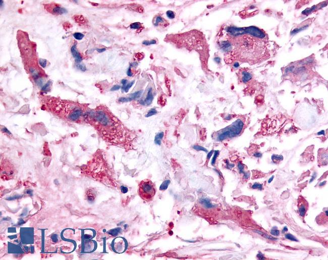 PAK6 Antibody - Brain, Glioblastoma