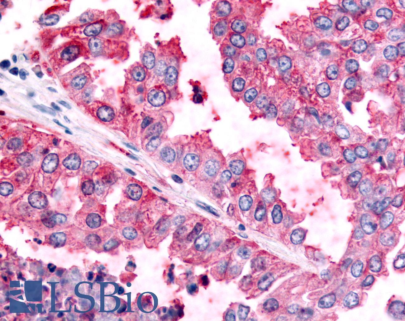 PAK6 Antibody - Lung, Non Small-Cell Carcinoma