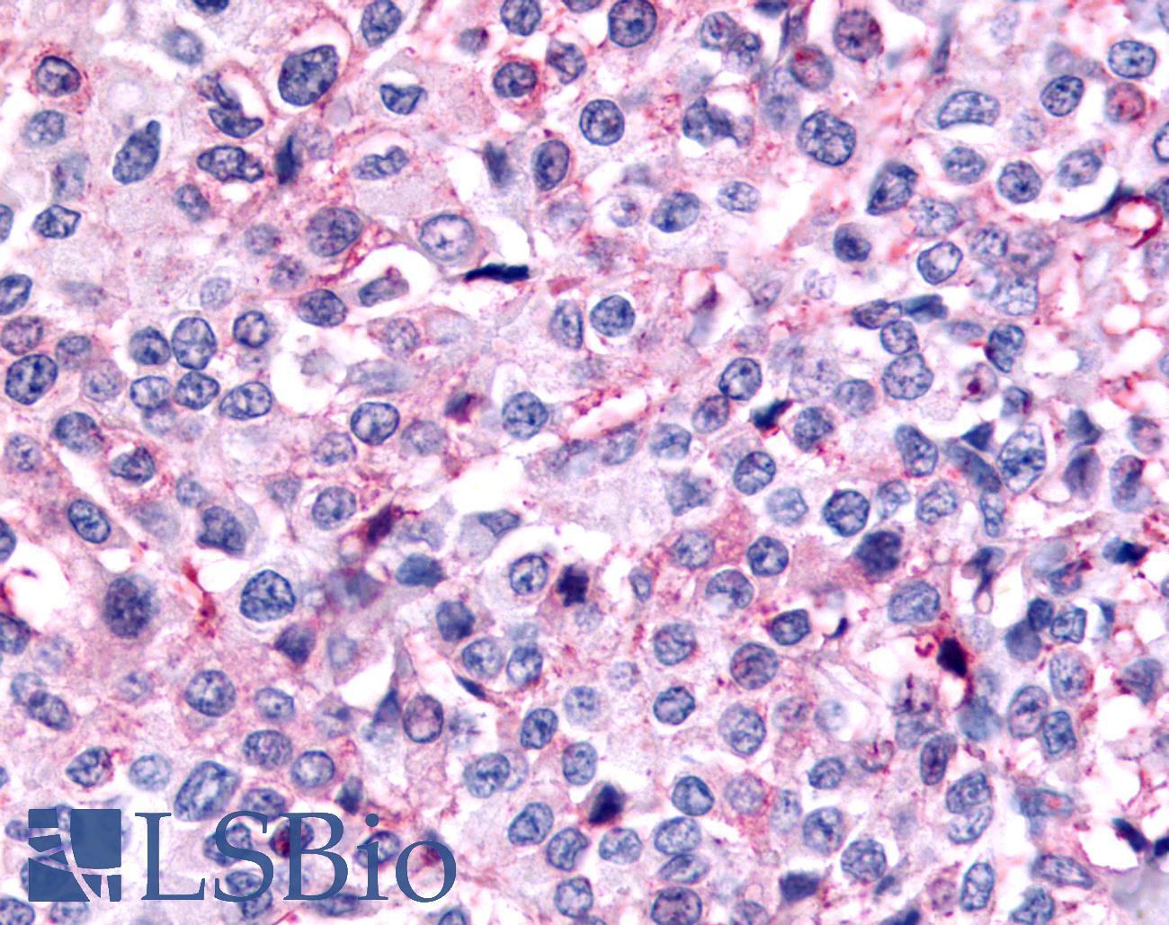 PAK6 Antibody - Breast, carcinoma