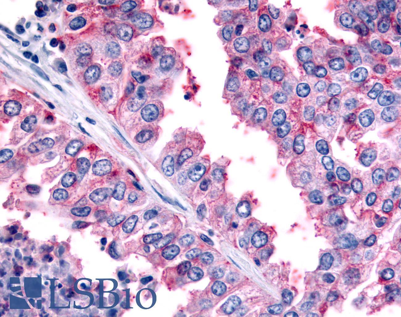 PAK6 Antibody - Lung, Non Small-Cell Carcinoma
