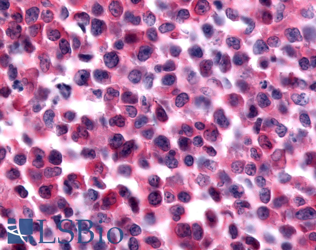 PAK7/PAK5 Antibody - Non-Hodgkin's lymphoma