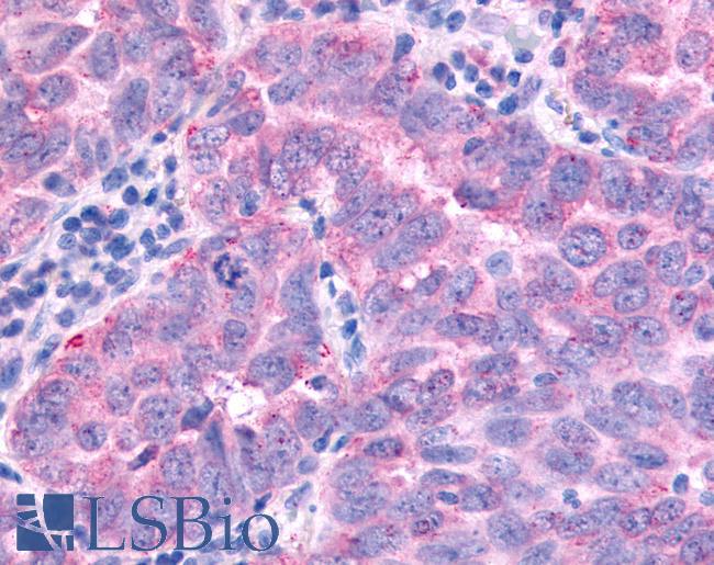 PAK7/PAK5 Antibody - Lung, Non Small-Cell Carcinoma