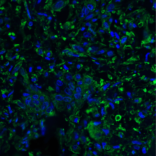PD-L2 / PDCD1LG2 / CD273 Antibody - Immunofluorescence of PD-L2 in human colon carcinoma tissue with PD-L2 antibody at 20 ug/mL. Green: PDL2 Antibody [10H6] Blue: DAPI staining