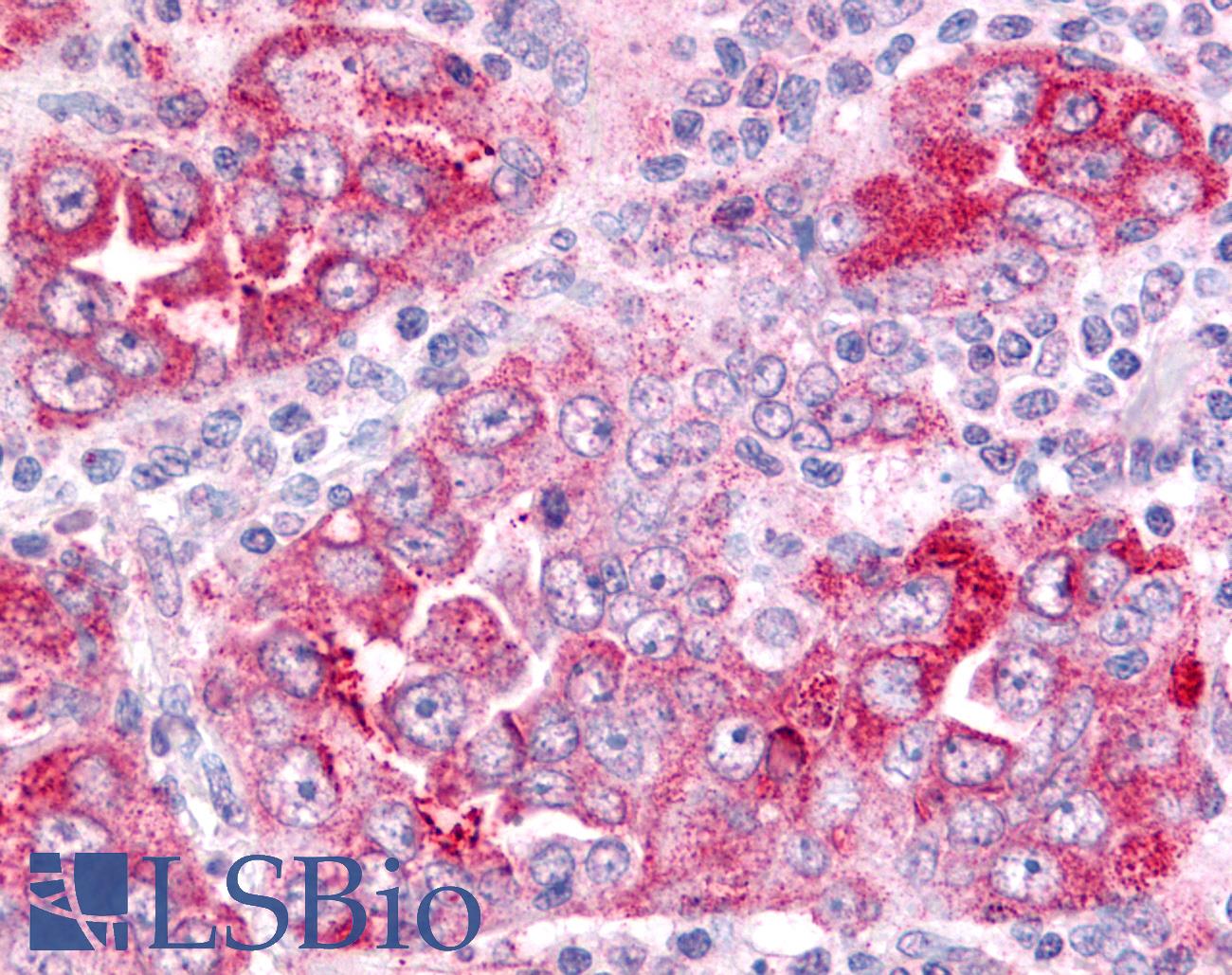 PGES / PTGES Antibody - Anti-PGES / PTGES antibody IHC of human Lung, Non-Small Cell Carcinoma. Immunohistochemistry of formalin-fixed, paraffin-embedded tissue after heat-induced antigen retrieval.