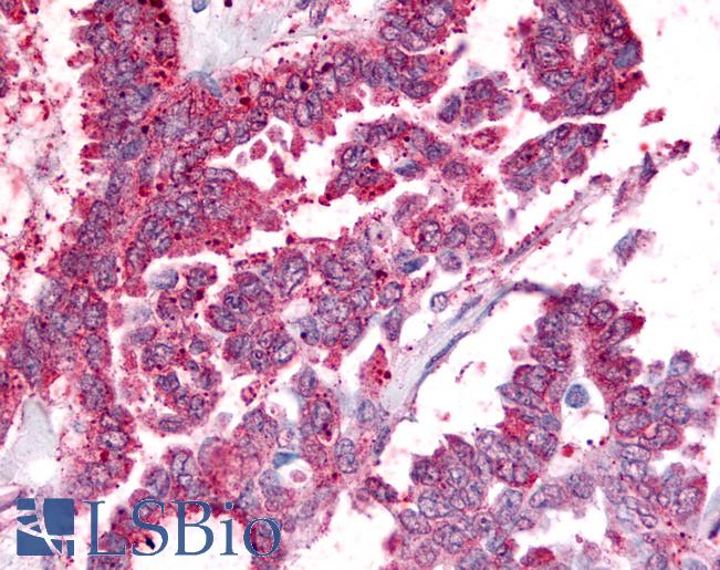 PGES / PTGES Antibody - Anti-PGES / PTGES antibody IHC of human Ovary, Carcinoma. Immunohistochemistry of formalin-fixed, paraffin-embedded tissue after heat-induced antigen retrieval.