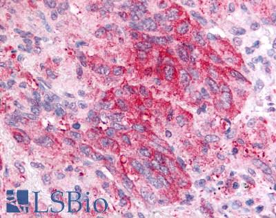 PGES / PTGES Antibody - Lung, non small cell carcinoma