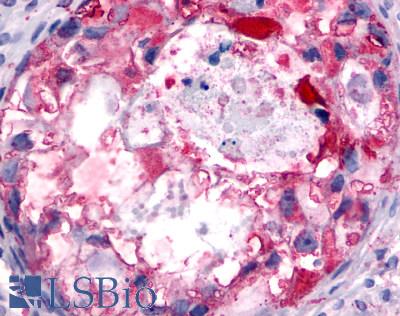 PGR1 / GPR153 Antibody - Ovary, Carcinoma