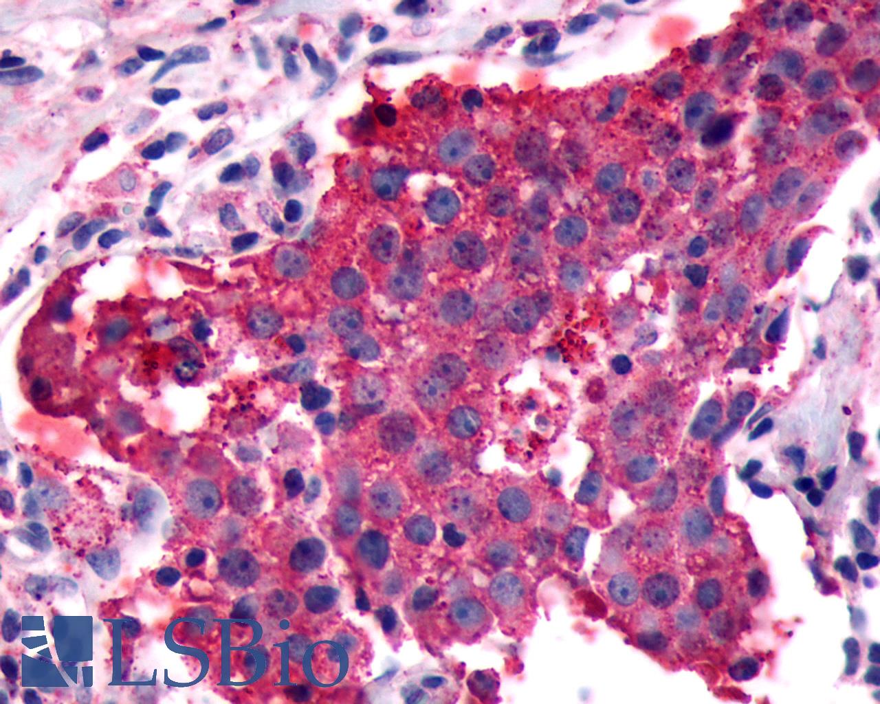 PGR1 / GPR153 Antibody - Anti-PGR1 / GPR153 antibody IHC of human Breast, Carcinoma. Immunohistochemistry of formalin-fixed, paraffin-embedded tissue after heat-induced antigen retrieval.