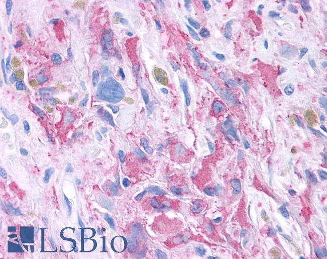 PKD3 / PRKD3 Antibody - Anti-PKD3 / PRKD3 antibody IHC of human Brain, Glioblastoma. Immunohistochemistry of formalin-fixed, paraffin-embedded tissue after heat-induced antigen retrieval.