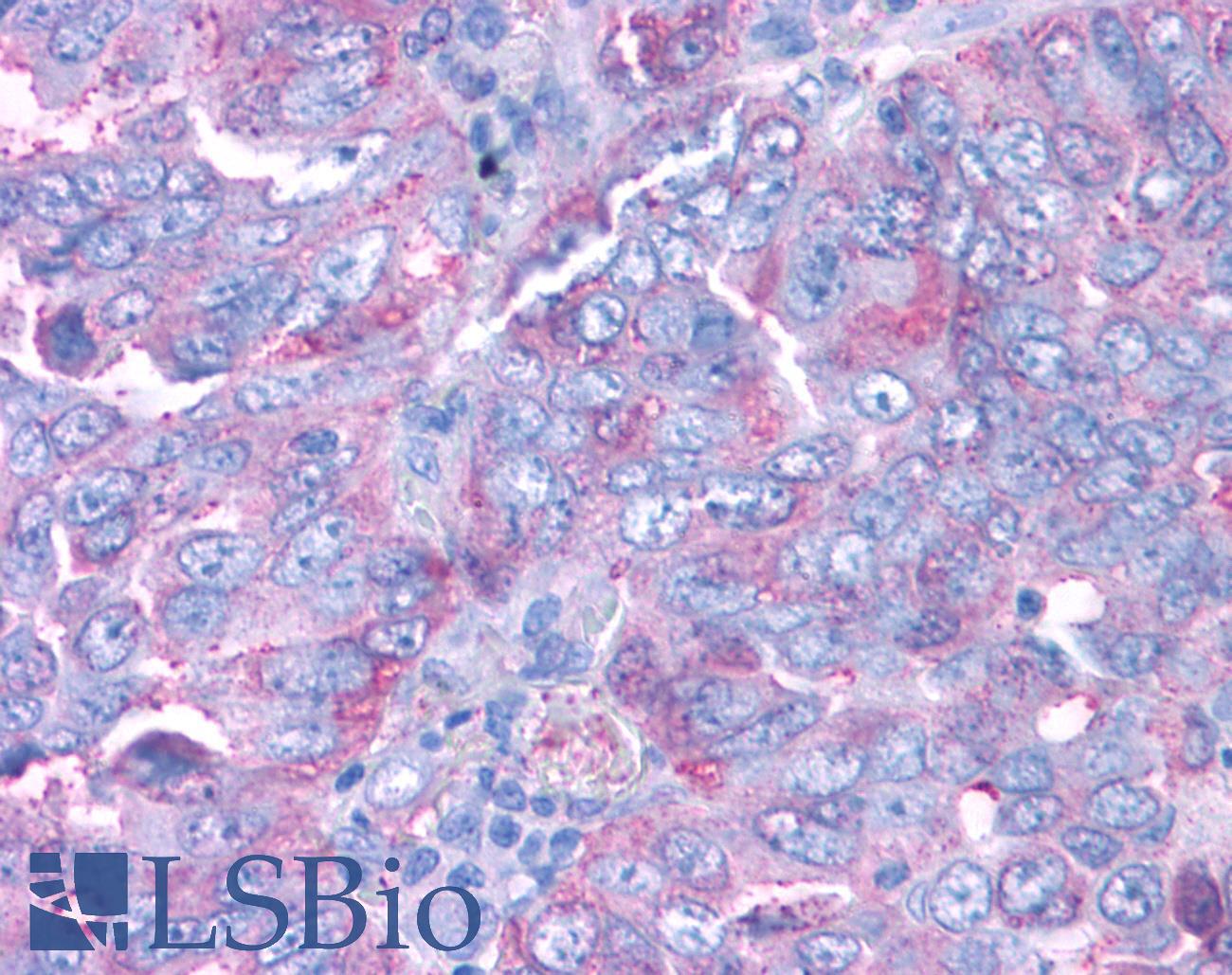 PKD3 / PRKD3 Antibody - Lung, Non Small-Cell Carcinoma