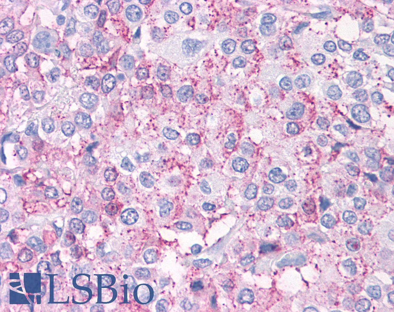 PKD3 / PRKD3 Antibody - Breast, Carcinoma