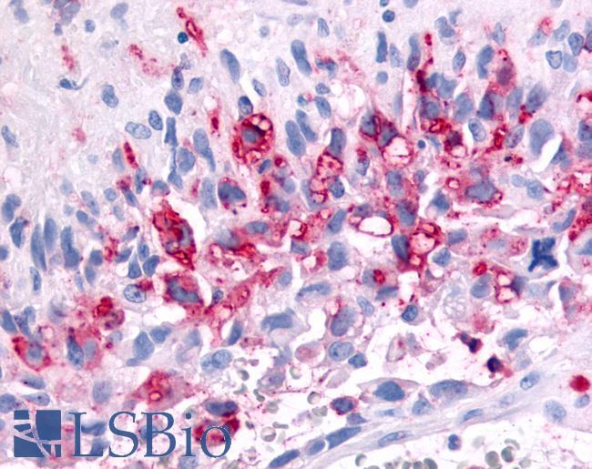 PRKD2 / PKD2 Antibody - Brain, Glioblastoma