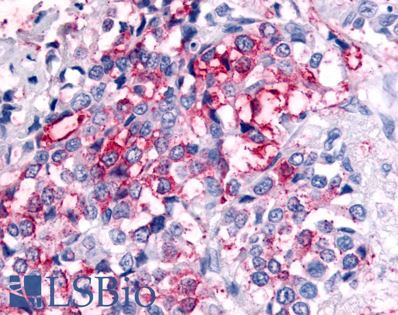 PRKD2 / PKD2 Antibody - Breast, carcinoma