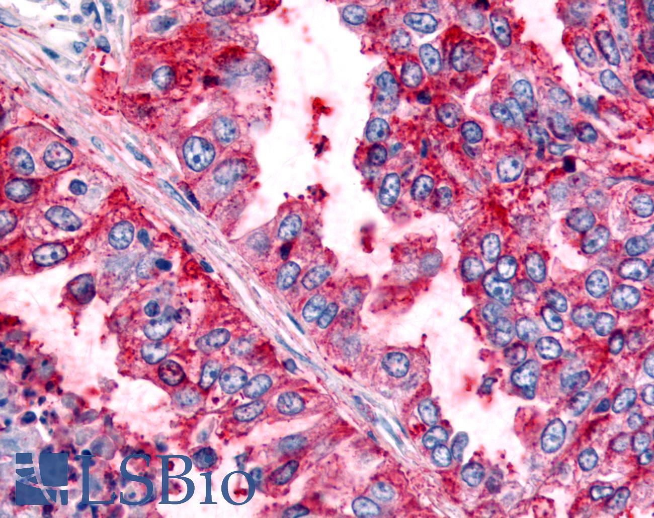 PRKD2 / PKD2 Antibody - Lung, Non Small-Cell Carcinoma