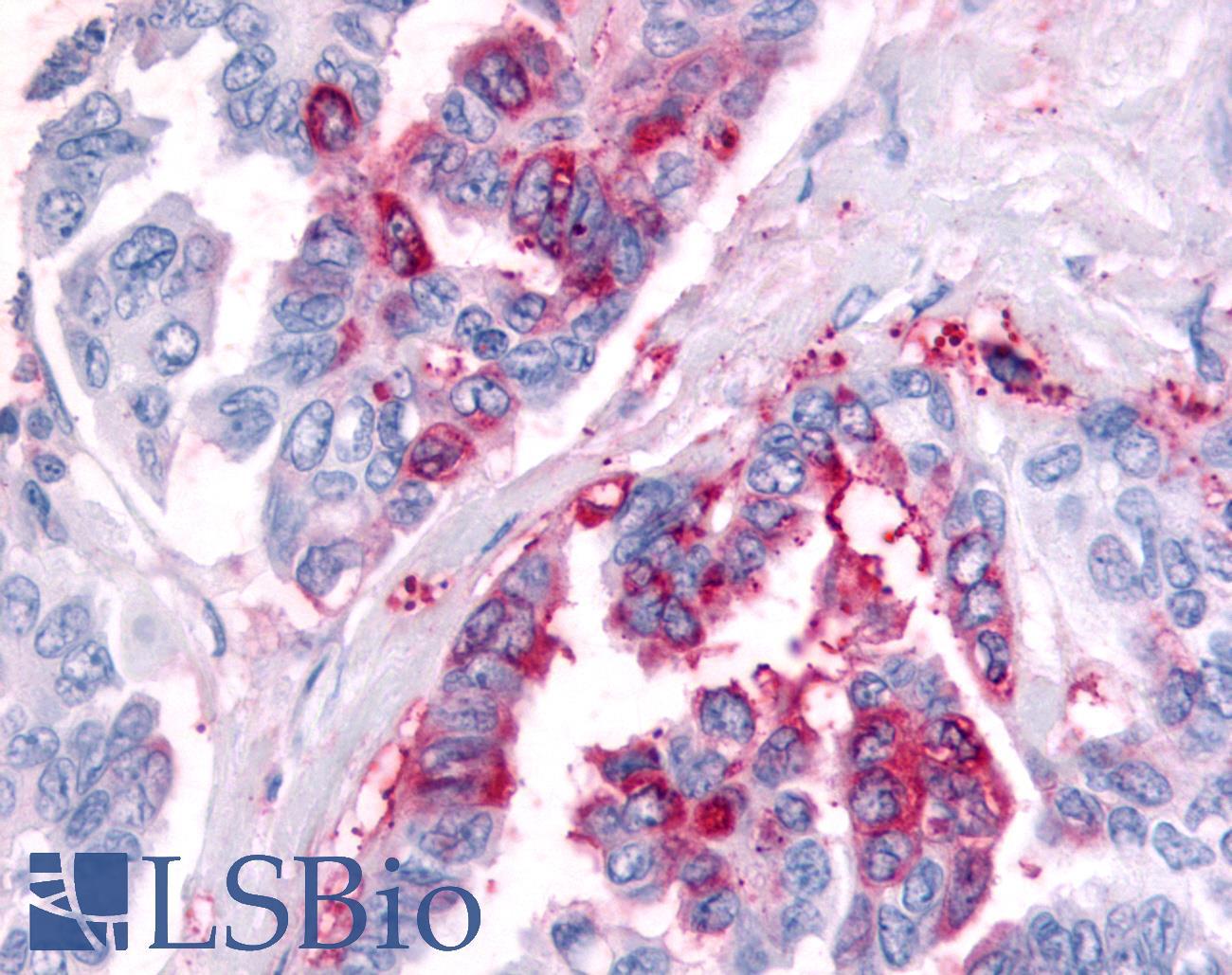 PRKD2 / PKD2 Antibody - Ovary, carcinoma