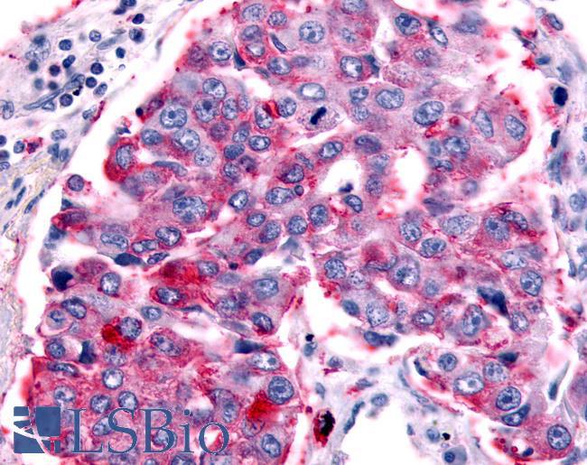 PTGER1 / EP1 Antibody - Lung, Non Small-Cell Carcinoma