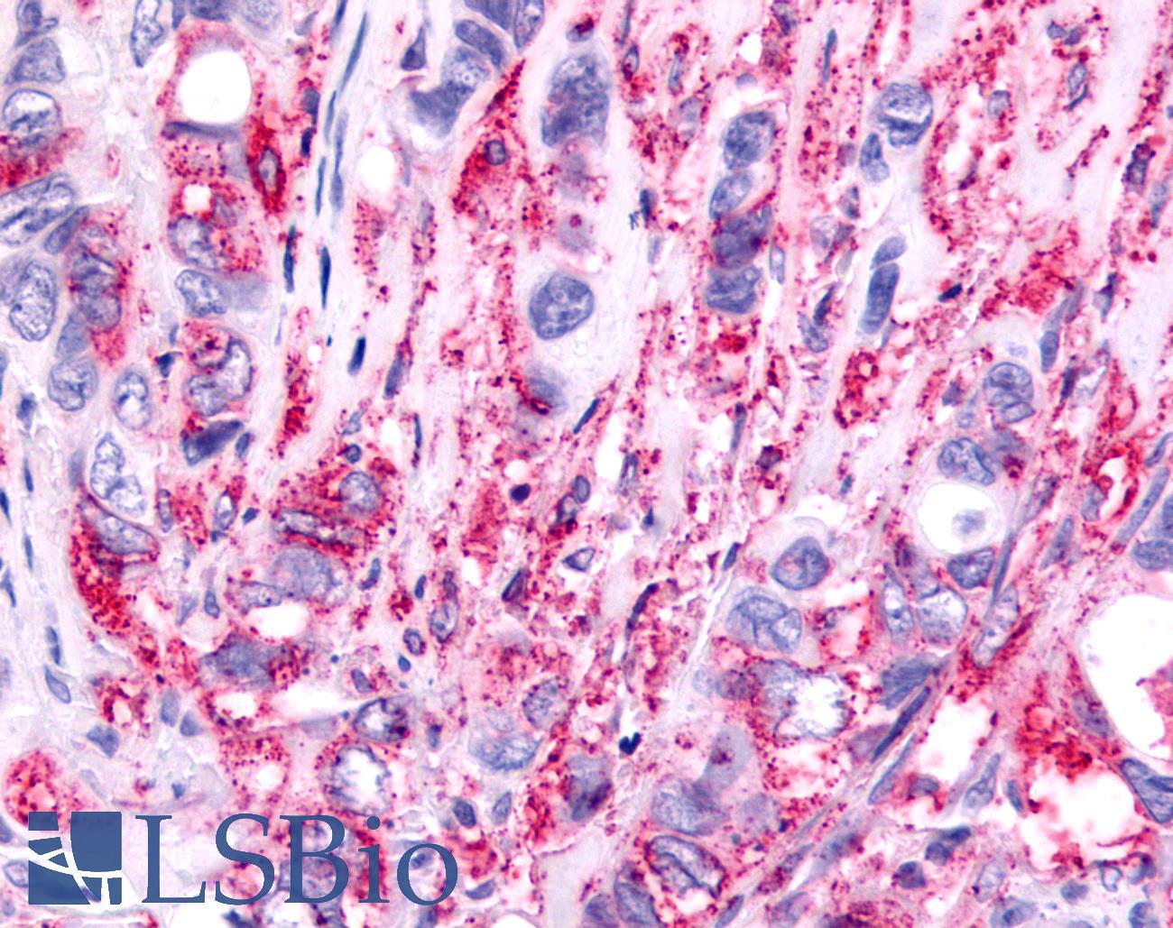 PTGER1 / EP1 Antibody - Colon, Carcinoma