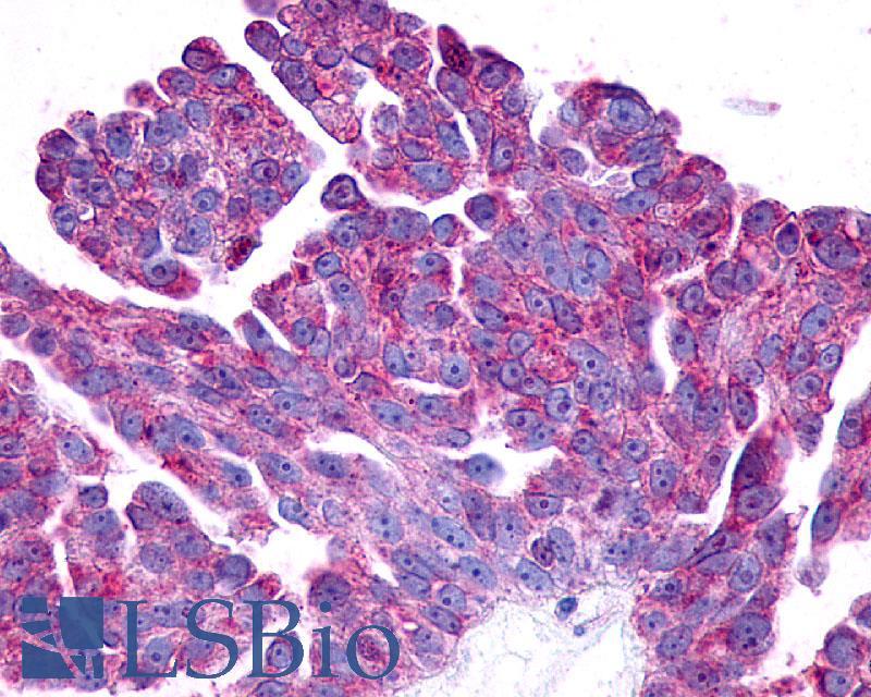 PTGER2 / EP2 Antibody - Ovary, carcinoma