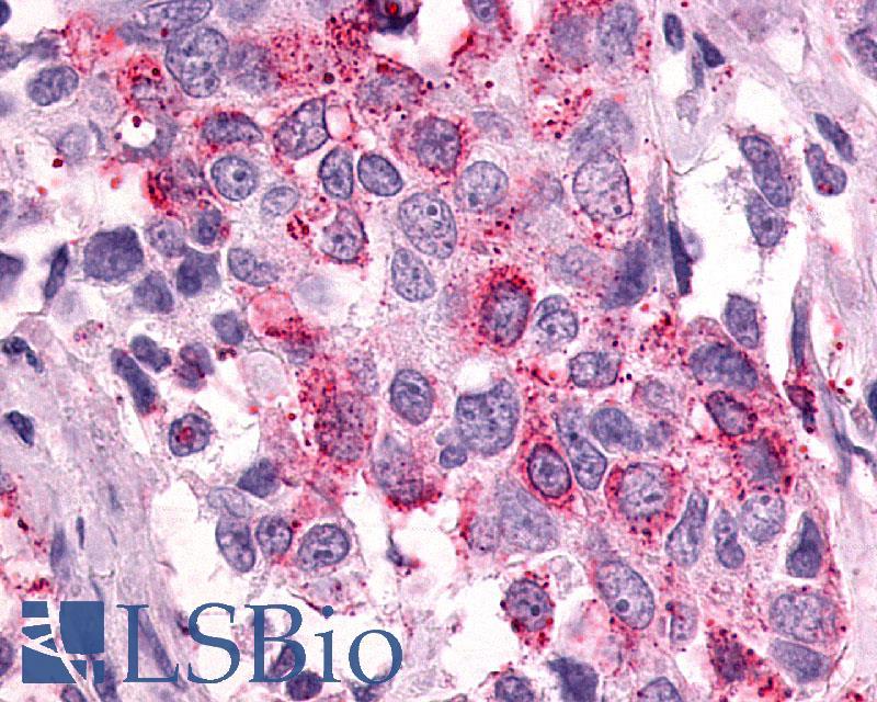 PTGER3 / EP3 Antibody - Breast carcinoma