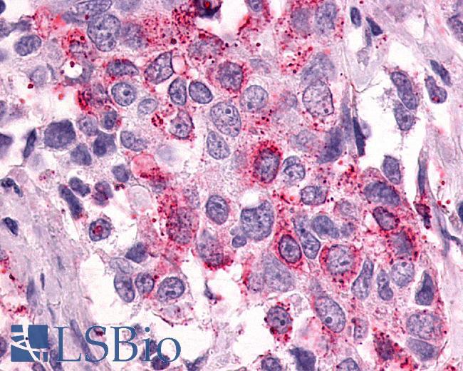 PTGER3 / EP3 Antibody - Breast carcinoma