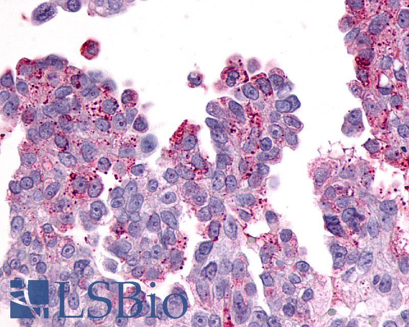 PTGER3 / EP3 Antibody - Ovary, carcinoma