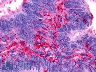 PTGER3 / EP3 Antibody - Colon, Carcinoma