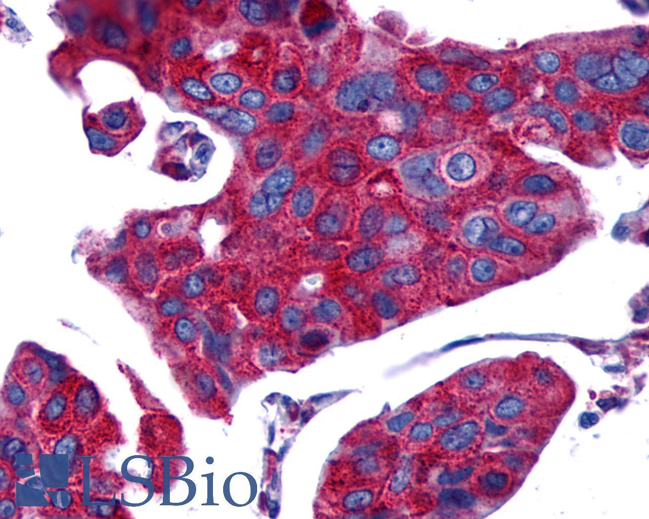 PTGER4 / EP4 Antibody - Breast, Carcinoma