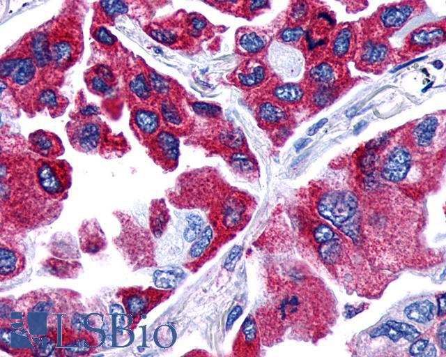PTGER4 / EP4 Antibody - Lung, non small cell carcinoma