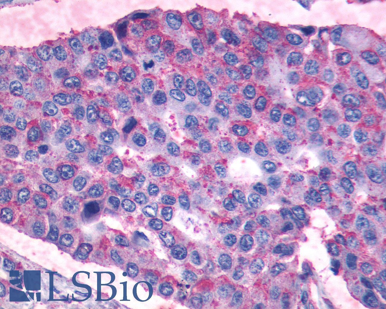 PTGIR / IP Receptor Antibody - Lung, Non Small-Cell Carcinoma