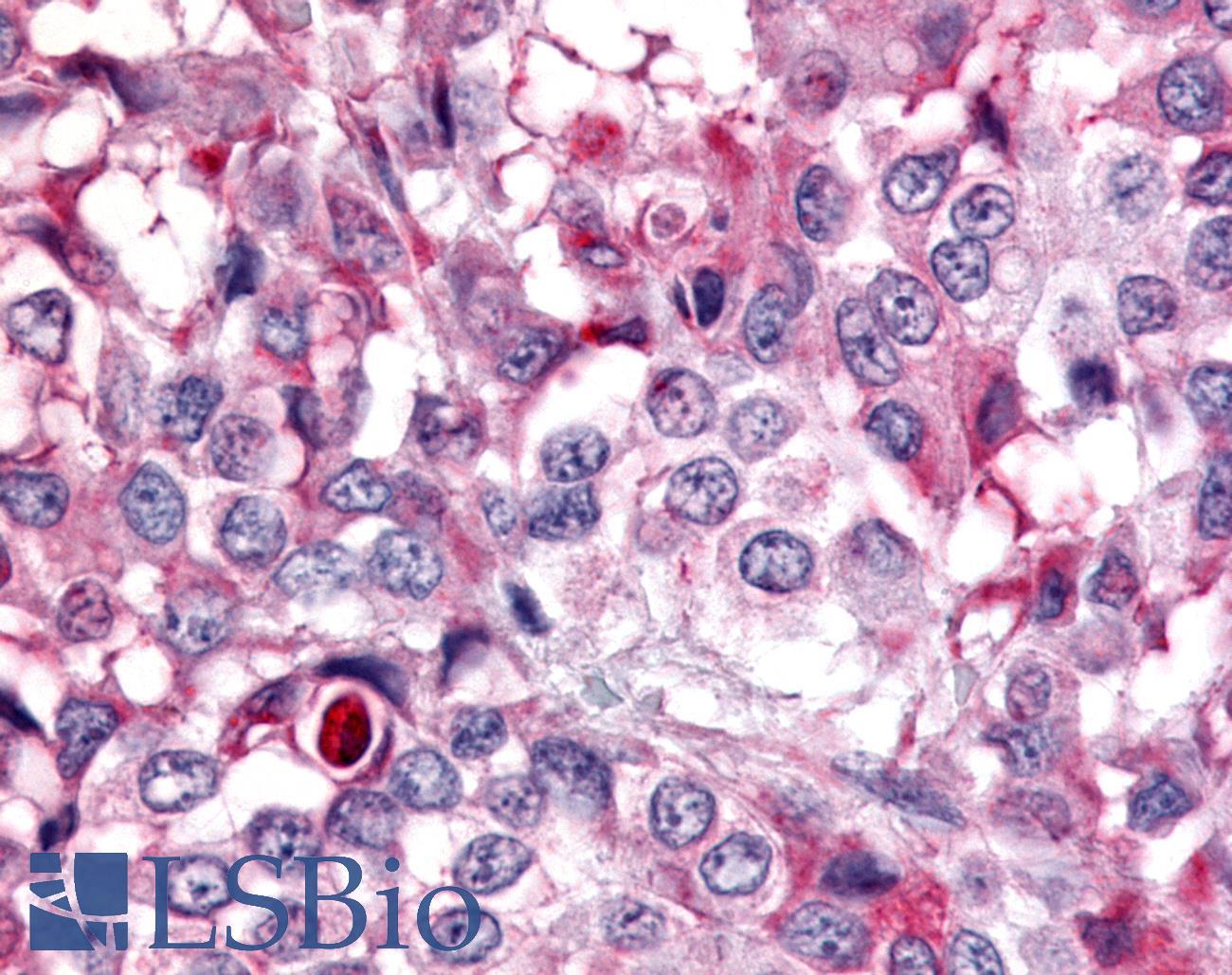 PTPRE / PTP Epsilon Antibody - Breast, Carcinoma