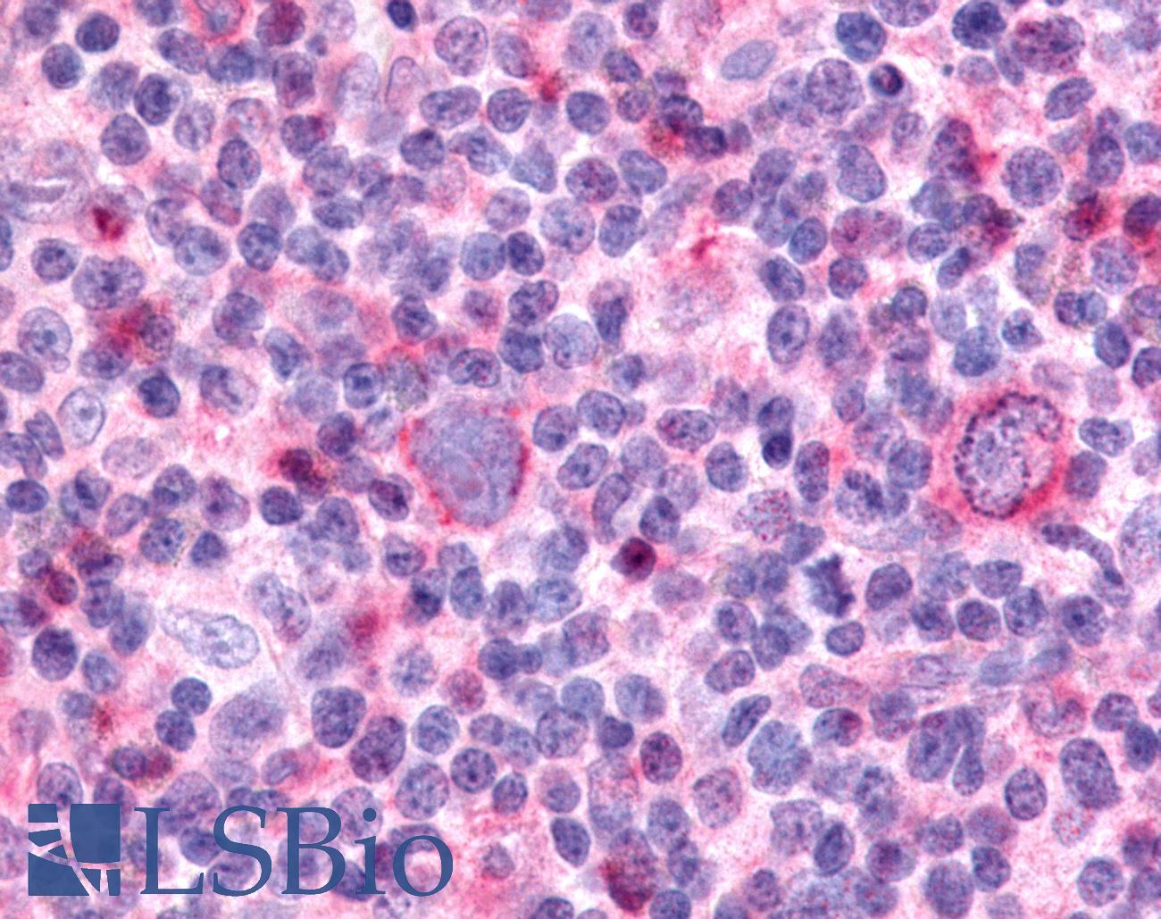 PTPRE / PTP Epsilon Antibody - Hodgkin's lymphoma