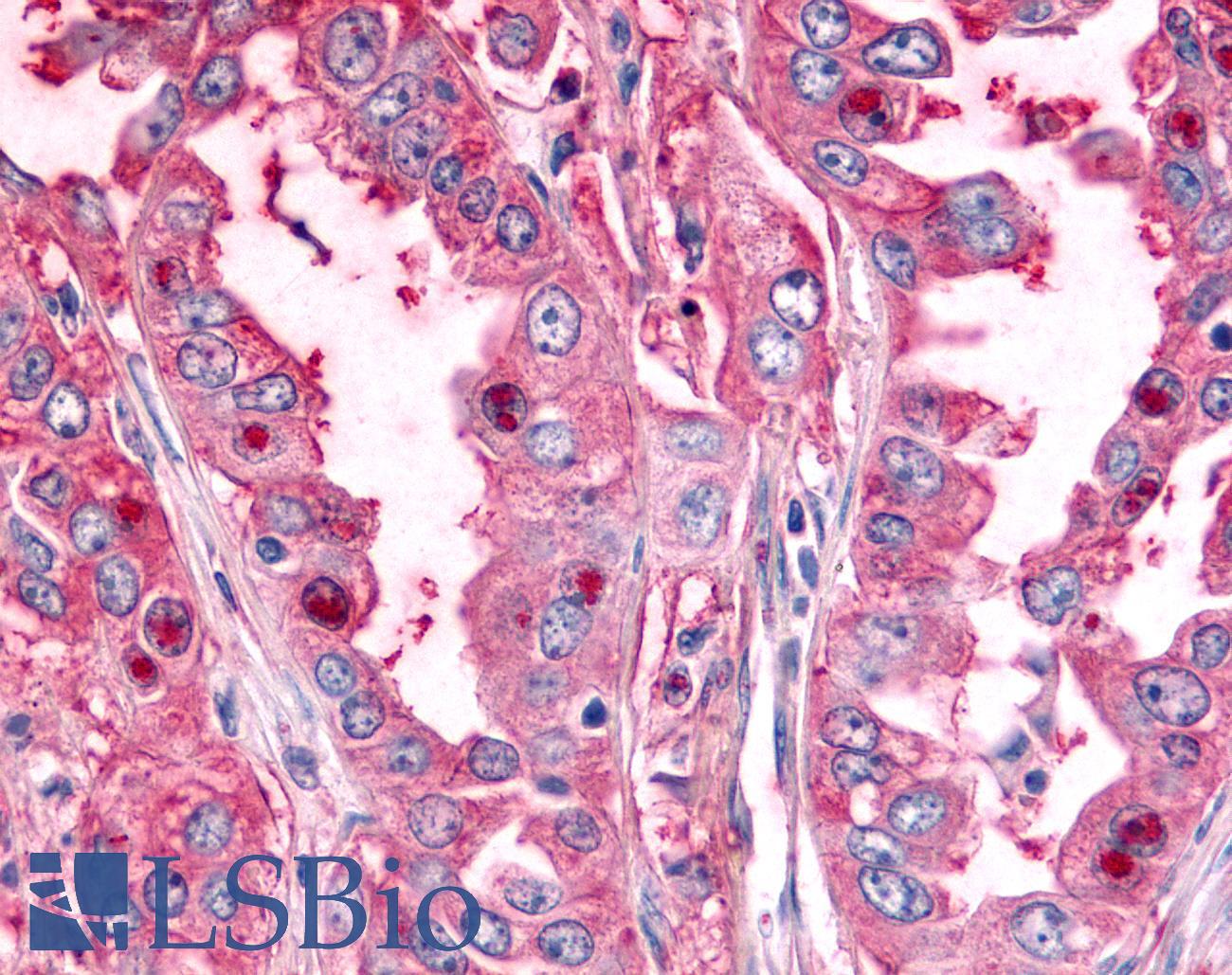 PTPRE / PTP Epsilon Antibody - Lung, Non Small-Cell Carcinoma
