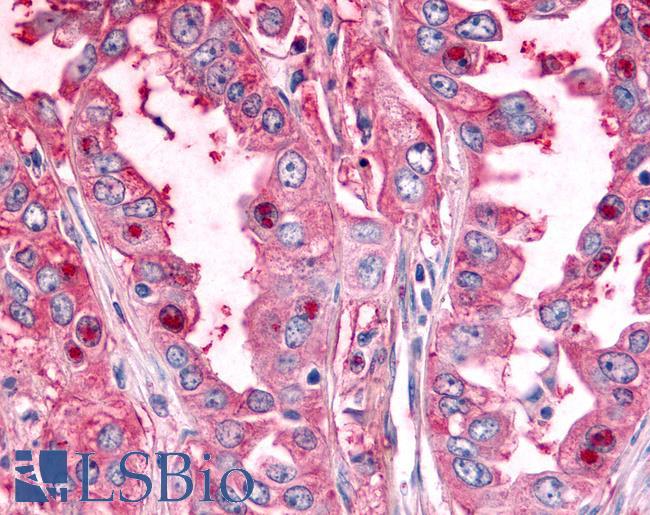 PTPRE / PTP Epsilon Antibody - Lung, Non Small-Cell Carcinoma